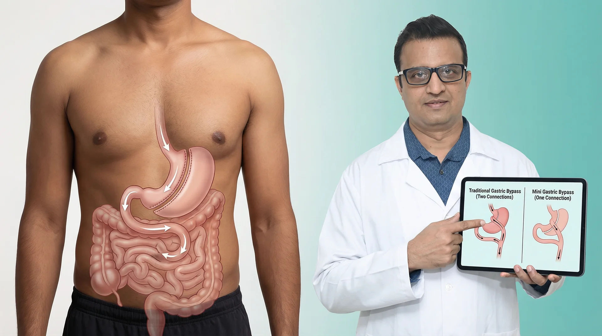 Laparoscopic One Anastomosis Gastric Bypass (OAGB) at Metabariatrics Mumbai